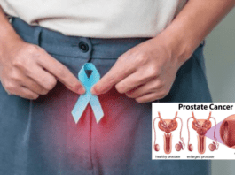 Prostate cancer