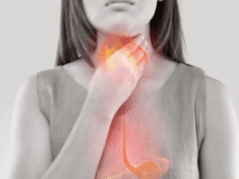 Heartburn
