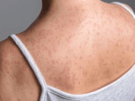 Beware of contagious diseases like measles