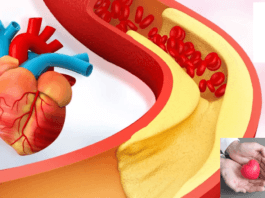 Does low cholesterol prevent heart attacks?